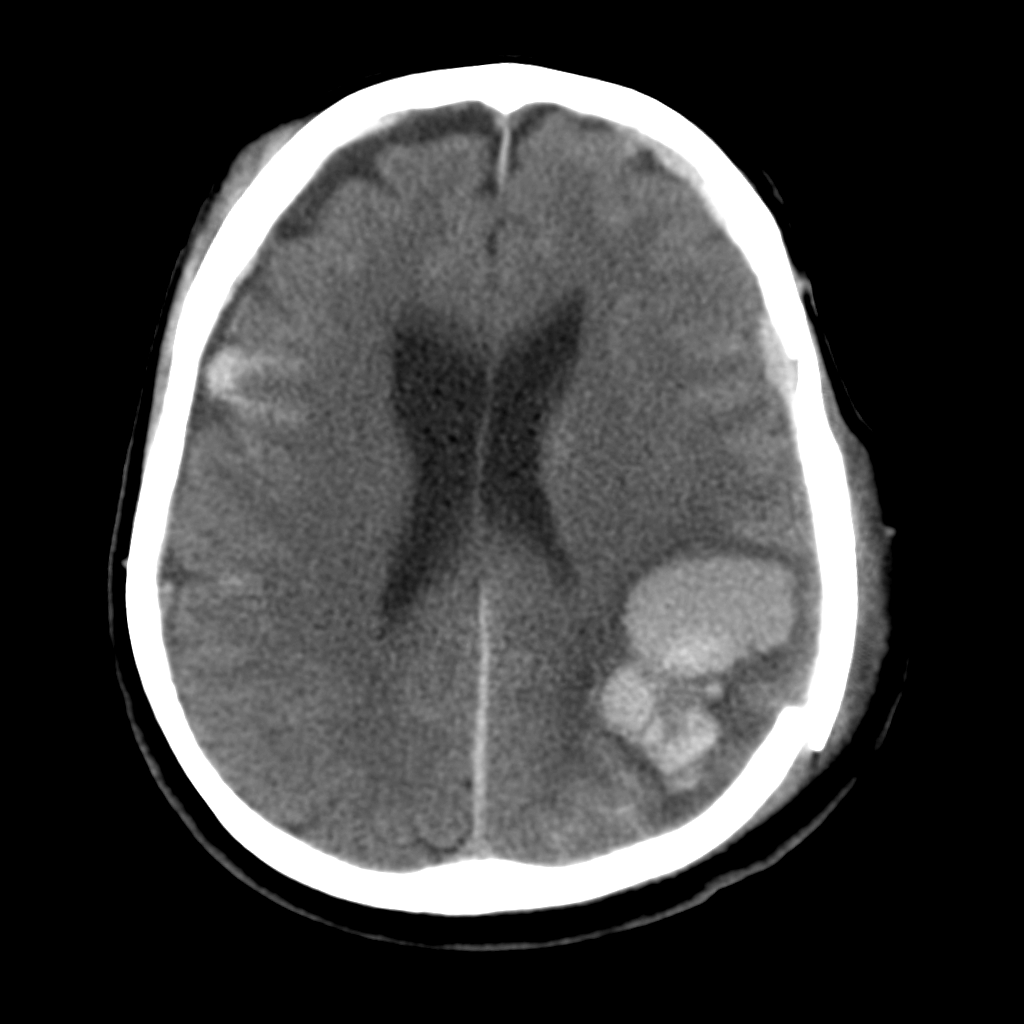 Гематома головного мозга. Контузионный очаг головного мозга кт.