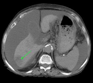 Рентген при раке поджелудочной железы thumbnail