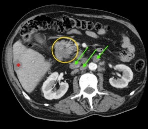 Компьютерная томография поджелудочной железы фото thumbnail