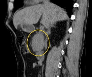 Компьютерная томография при раке поджелудочной железы thumbnail