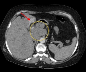 Компьютерная томография при диагностики рака поджелудочной железы thumbnail