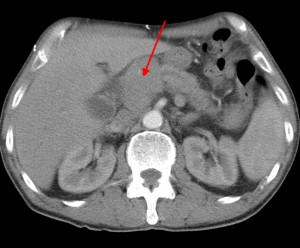 Рак поджелудочной железы компьютерная томография thumbnail