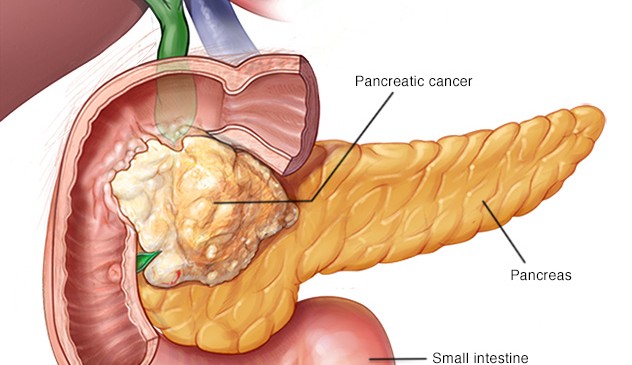 КТ и МРТ в диагностике рака поджелудочной железы