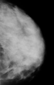 Расшифровка маммографии молочных желез 35