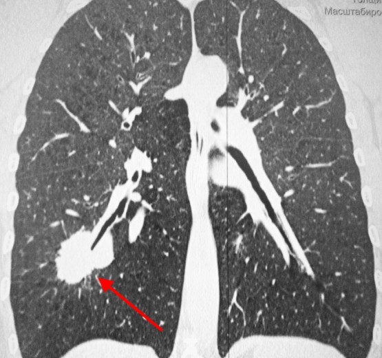 Уплотнения в легких на компьютерной томографии что это