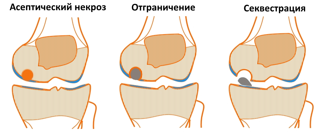 Некроз коленного сустава лечение. Асептический некроз мыщелка бедренной кости кт. Болезнь Кенига коленного сустава. Болезнь Кенига коленного сустава кт. Асептический некроз мыщелка бедра.