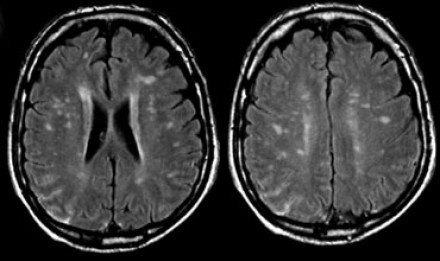 Мрт головного мозга в белом веществе очаги гиперинтенсивного сигнала thumbnail