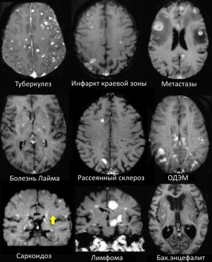 Мр картина единичных супратенториальных очагов глиоза