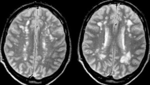 Мр картина очаговых изменений вещества мозга