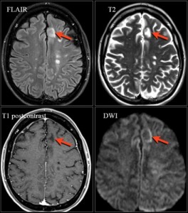 Мр картина очаговых изменений вещества мозга