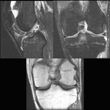 Мр картина лигаментита дистрофически измененной передней крестообразной связки