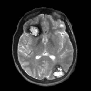 Ангиома головного мозга фото мрт thumbnail