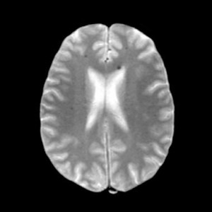 Кавернозная ангиома головного мозга и головная боль thumbnail