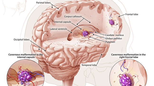 Кавернозная ангиома головного мозга лечение и диагностика