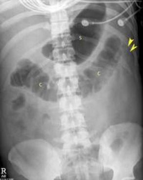 Рентгенологические признаки хронического панкреатита thumbnail
