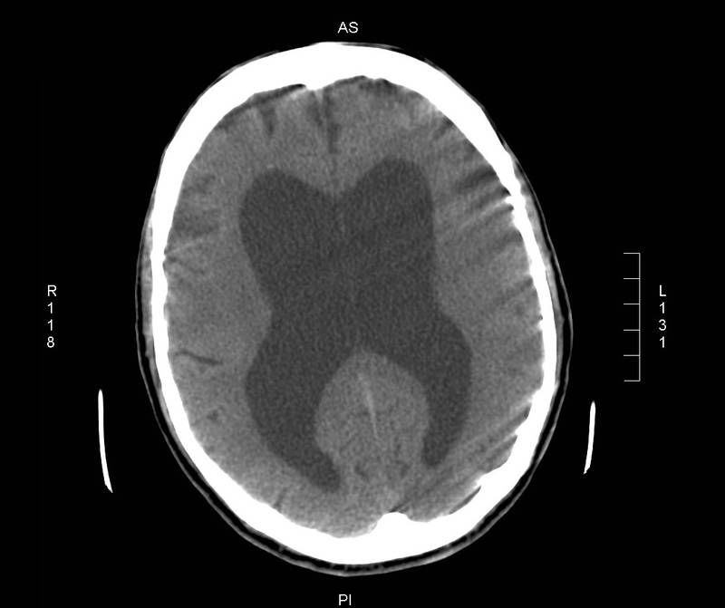 Фотографии мрт мозга при гидроцефалии thumbnail