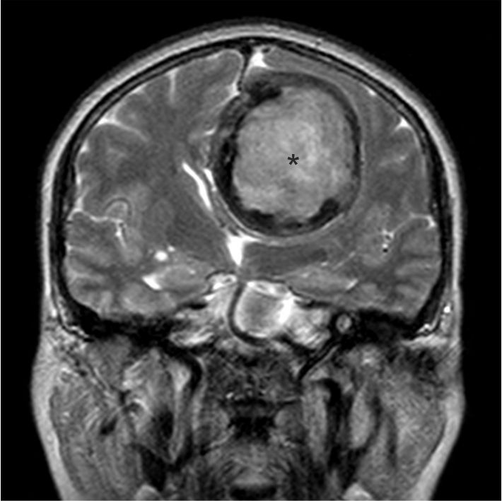 Как выглядит опухоль головного мозга на снимке МРТ