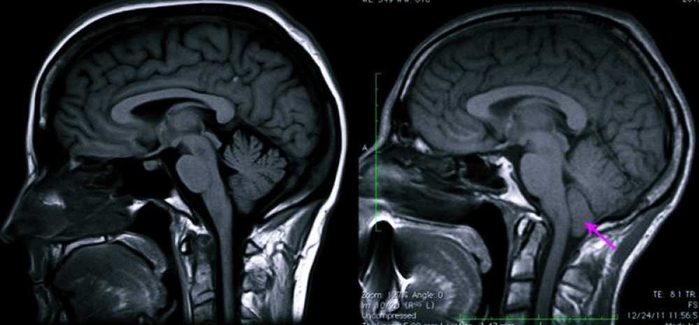 Мр картина низкого расположения миндалин мозжечка