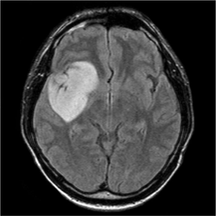 Как выглядит опухоль головного мозга на снимке МРТ Второе