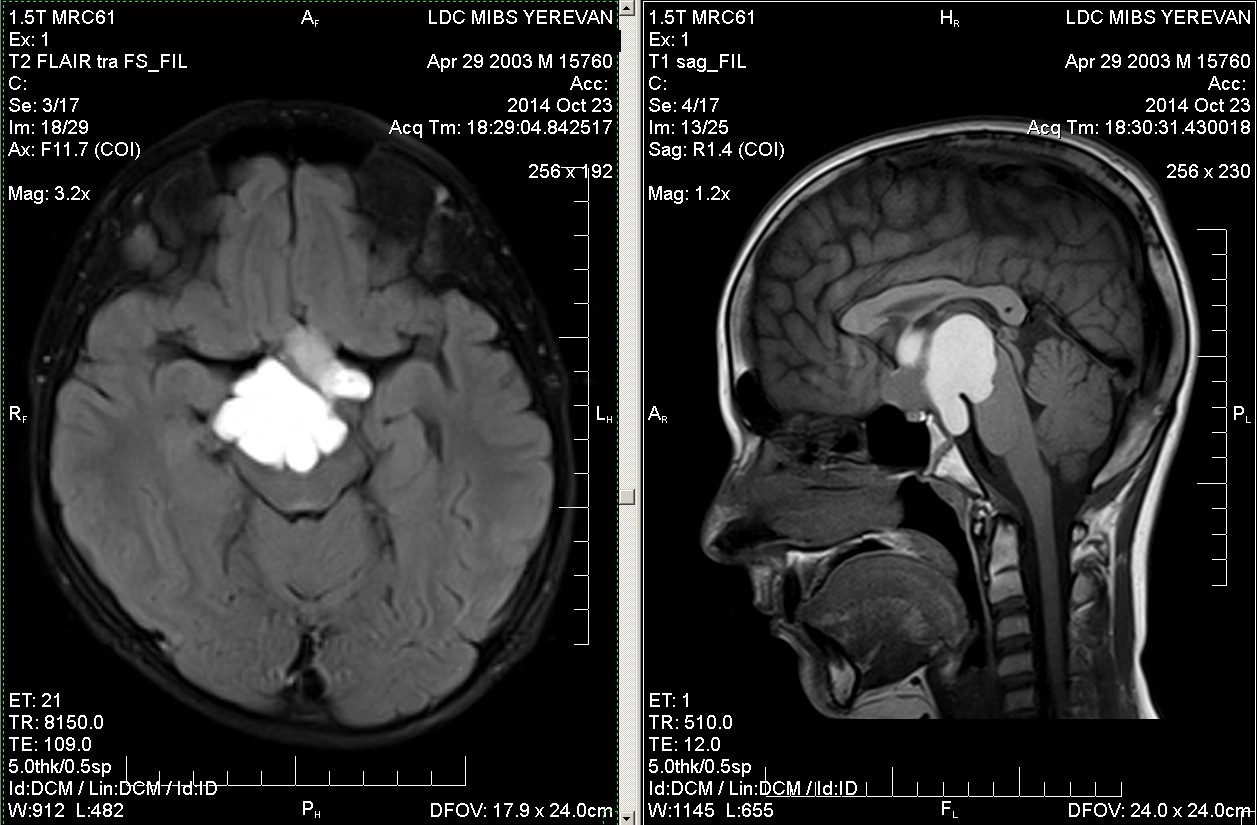 Какова роль МРТ в диагностике опухолей головного мозга