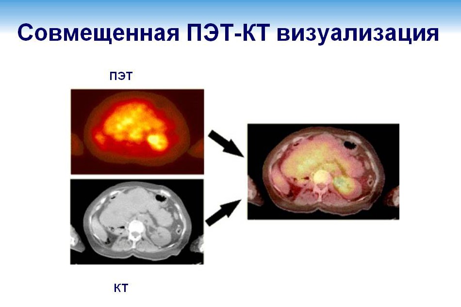 Позитронно-эмиссионная томография ...что это