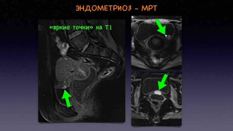 Ретроцервикальный эндометриоз фото
