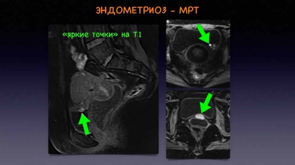 Эндометриоз томография