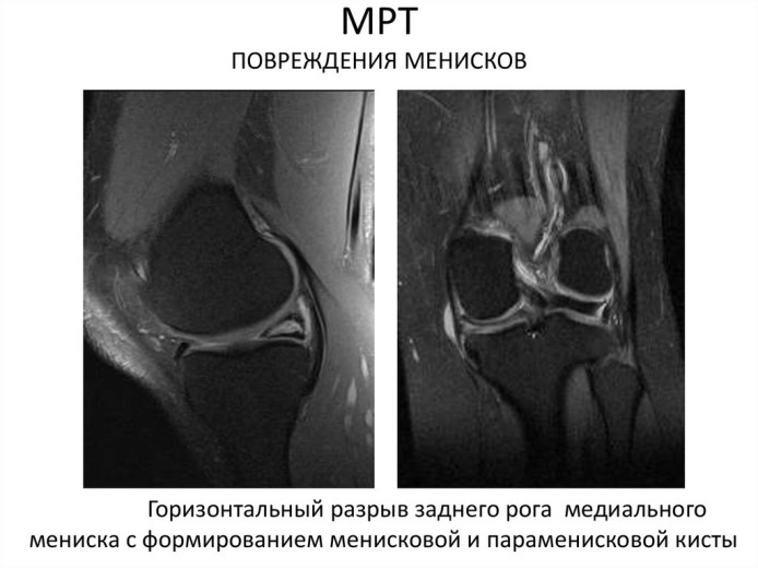 Где находится мениск схема колена