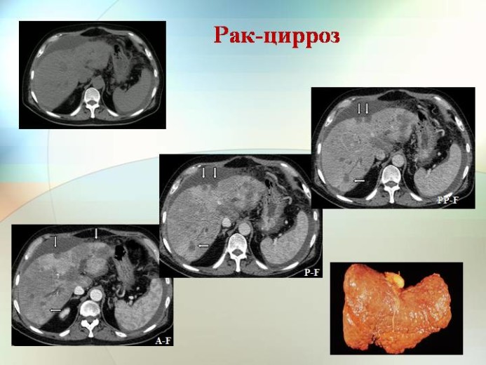 Рак печени фото