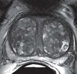 Мр картина гиперплазии предстательной железы