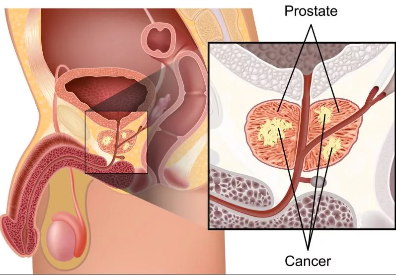 Dr. Alina Turcu, Oncolog: “Depistat precoce, cancerul de prostată poate fi tratat eficient” | VIDEO